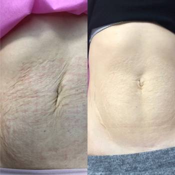 Фракционный RF( лечение растяжек,укрепление,омоложение кожи