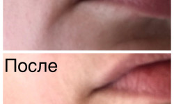 RF лифтинг Косметолог Елена Воронцова Кривой Рог