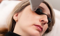 Лазерное лечение пигментации Косметологічний центр Celebriti Черкаси