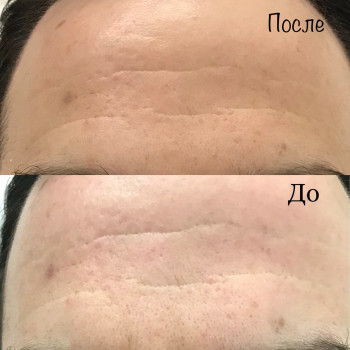 Массаж Угол молодости (лицо, шея, декольте)
                    Косметолог Елена Ивано-Франковск