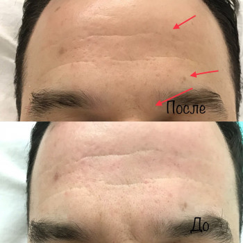 Массаж Угол молодости (лицо, шея, декольте)
                    Косметолог Елена Ивано-Франковск