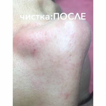 Глубокая чистка лица:ПОСЛЕ процедуры