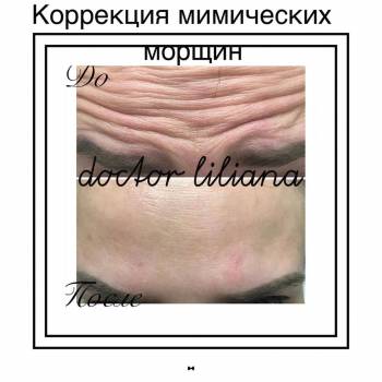 уколи ботокса для обличчя, корекціяз моршок