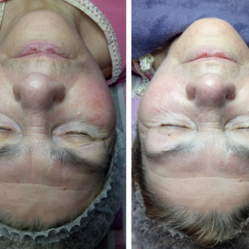 комбинированная чистка лица (ультразвук+мануально) + карбокс