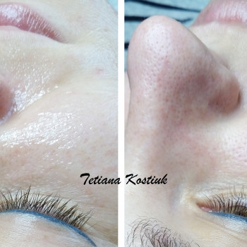 комбинированная чистка лица (ультразвук+мануально)