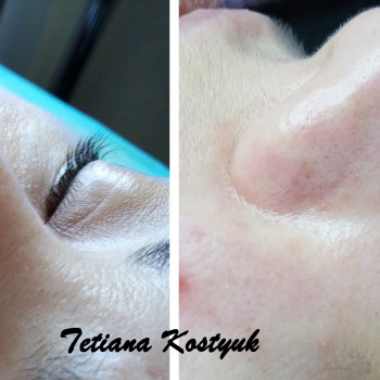 комбинированная чистка лица (ультразвук+мануально)