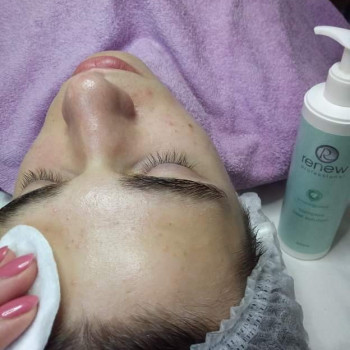 Чистка комбинированная лица, спины, декольте
                    Салон красоты BeautySkin Киев