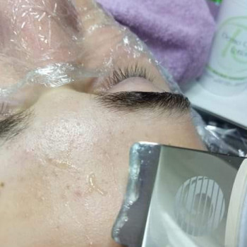 чистка лица, этап - очищение пор ультразвуком