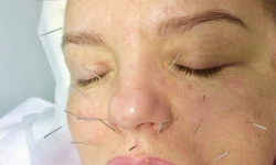 Face Lifting Acupuncture (голки) Масажист Николай Київ