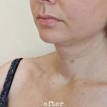 Липолитик Маурицио Чеккарели. ПОСЛЕ. FAT APOPTOSIS M