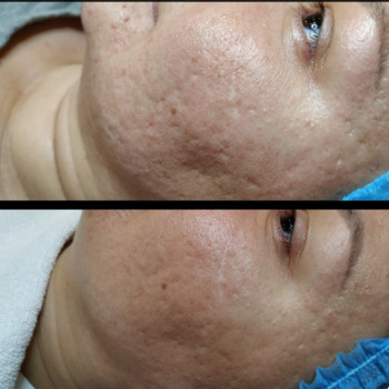 После 2ух процедур мезотерапии, фото - косметолог Олеся Разкевич