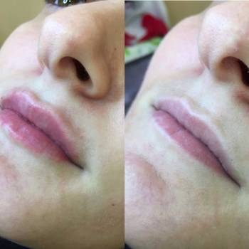 увеличение губ