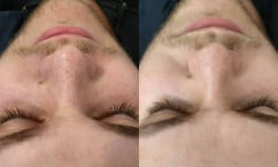 Комбинированная чистка лица Косметолог Алина Савкина Харків