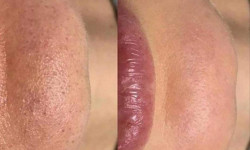 Механическая чистка лица Косметолог Алина Савкина Харьков