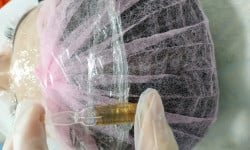 Мезотерапия против акне Косметолог Алина Савкина Харків