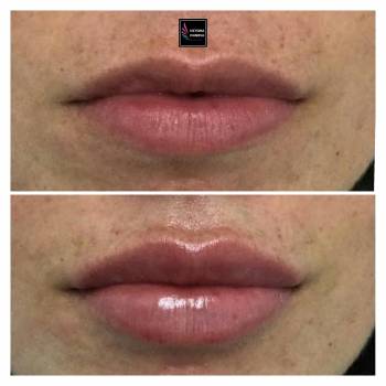 Контурная пластика губ