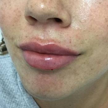 Контурная пластика губ