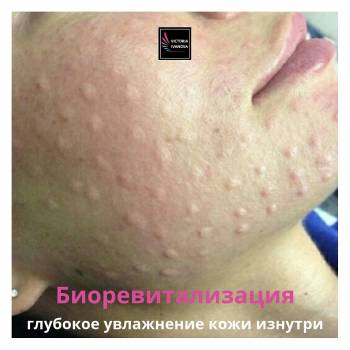 Биоревитализация