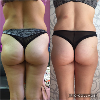 Комплексные липолитические корректирующий процедуры