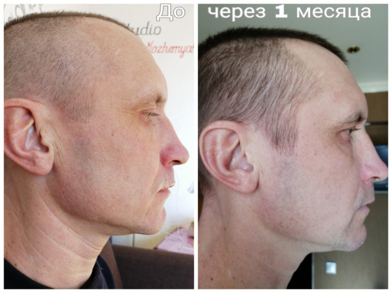 Результат через 1 міс
 #лазернеомолодження
 #безопераційнаблефаропластика, фото - Косметолог-эстетист Инна Кожемякина