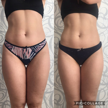 Вакуумно-роликовый массаж
                    Масажист Юлия Полтава