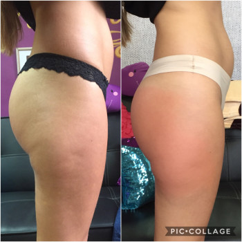 Вакуумно-роликовый массаж
                    Масажист Юлия Полтава