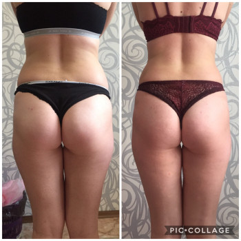 Вакуумно-роликовый массаж
                    Масажист Юлия Полтава