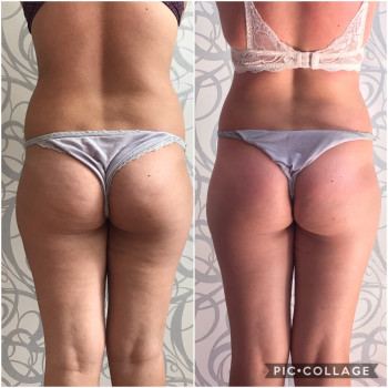 Вакуумно-роликовый массаж
                    Масажист Юлия Полтава