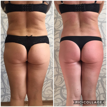 Вакуумно-роликовый массаж
                    Масажист Юлия Полтава