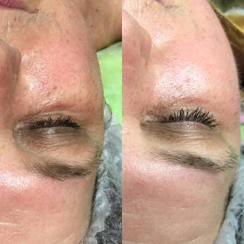 Результат после 7 й процедуры массажа лица