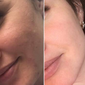 домашний уход + салоны процедуры!интервал между фото 3 месяц