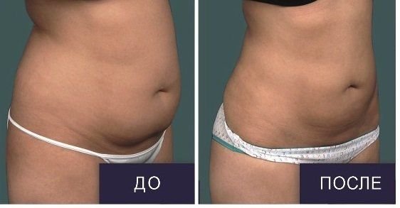 Липоредукция фото до и после отзывы