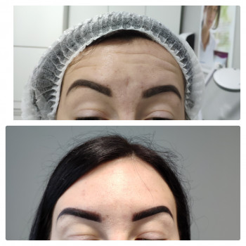 Ботулотерапія препаратом "BOTOX"
                    Косметолог Катерина Винница