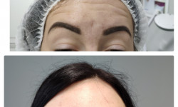 Ботулотерапія препаратом "BOTOX" Косметолог Катерина Зацерковна Винница