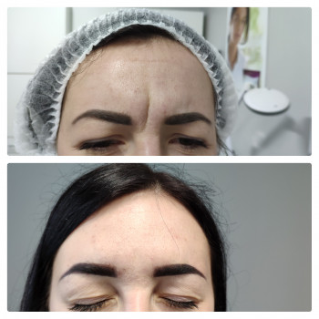 Ботулотерапія препаратом "BOTOX"
                    Косметолог Катерина Винница