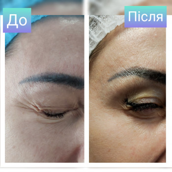 Ботулотерапія препаратом "BOTOX"
                    Косметолог Катерина Винница