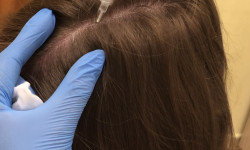 Мезотерапия головы Лікар-косметолог Неля Константиновна Київ