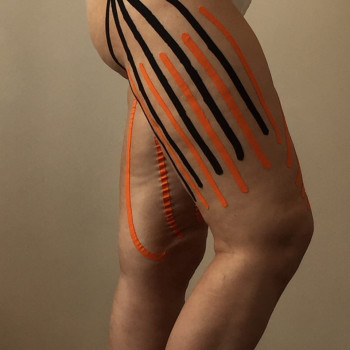 Тейпирование бедер - подтяжка и лифтинг