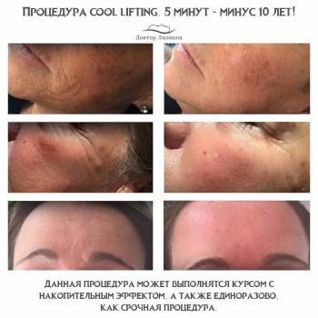 уход за лицом, коррекция морщин, косметология лица