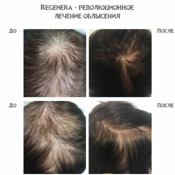 Карбокситерапия