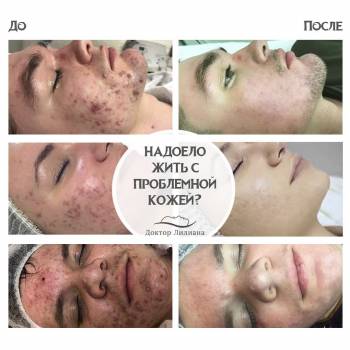 Комплексное лечение проблемной кожи