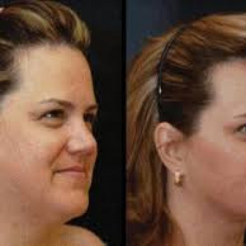 Диполитик нижняя треть