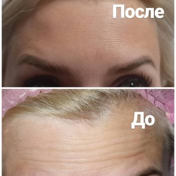 Ботулинотерапия