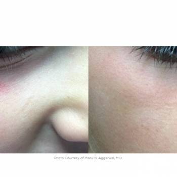 Телеангиэктазия