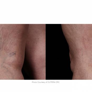 Вены на ногах