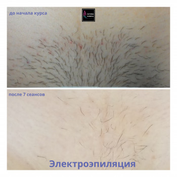 Электроэпиляция. Удаление волос НАВСЕГДА