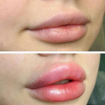 Увеличение губ, коррекция формы.