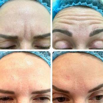 Разглаживание морщин (лоб, межбровье, носогубные складки), м