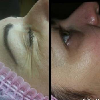 Nanoasia безиньекционное омоложение кожи до и после