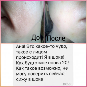 Проведен курс биоревитализации